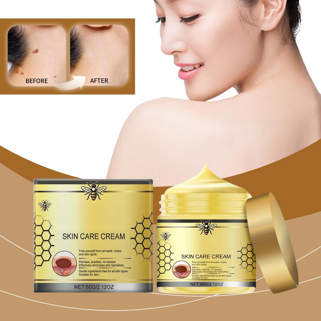 Verruca Care Cream Gentle Cleansing, Moisturizing And Softening The Skin, Reducing Skin Discomfort.