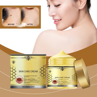 Verruca Care Cream Gentle Cleansing, Moisturizing And Softening The Skin, Reducing Skin Discomfort.