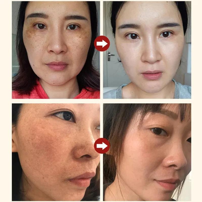 Crème blanchissante efficace pour les taches de rousseur, élimine le mélasma, atténue les taches brunes, hydrate, éclaircit la peau du visage, produit de soin