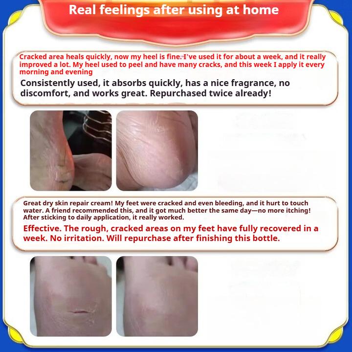 Kräm för spruckna fötter, kräm för spruckna hälar, spruckna händer och fötter, svampinfektion, salva för fjällning och sprickbildning [Köp mer för fler rabatter]