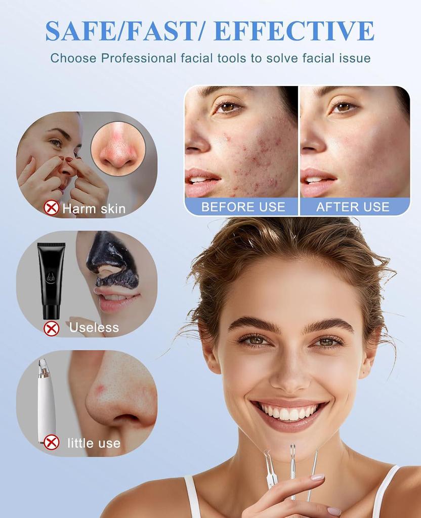 Stainless Steel Double Loop Pimple Extractor Tweezers Set for Blackhead and Acne Removal.