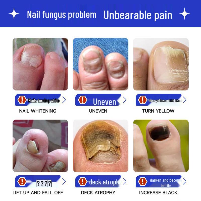 Baibang Qiling Nail Fungus Treatment