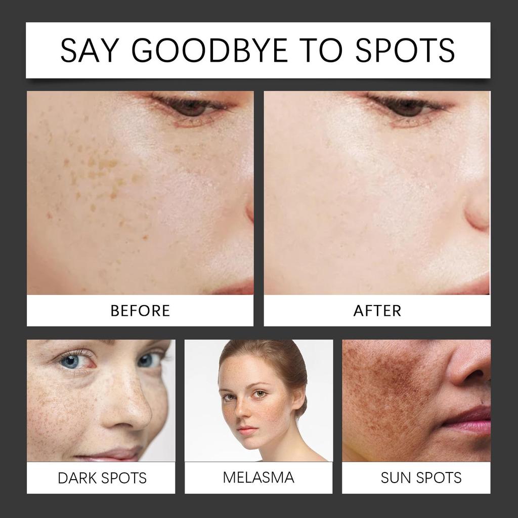 OUHOE Bee Venom Dark Spot Repair Essence Lightens Dark Spots, Enhances Skin Radiance and Brightness, Skin Care 30ml