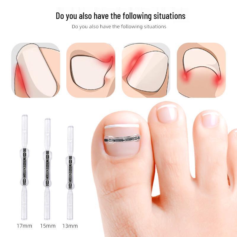 Double-Wing NiTi Alloy Bionic Bone Patch for Ingrown Toenail Correction (Invisible Physical Assistance Device).