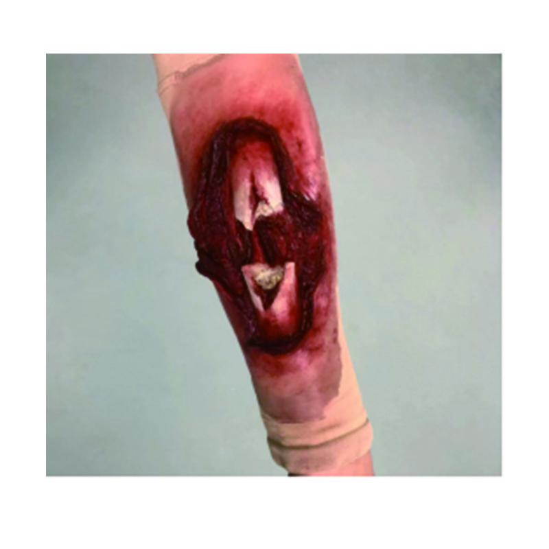 AWR Forearm Ulna Fracture First Aid Kit