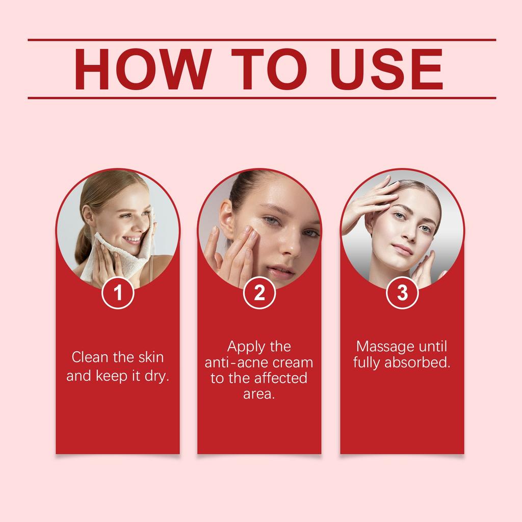 Acne Cream 35g Intensive Acne Cream To Reduce Pimples And Pimples, Suitable For All Skin Types And Ages