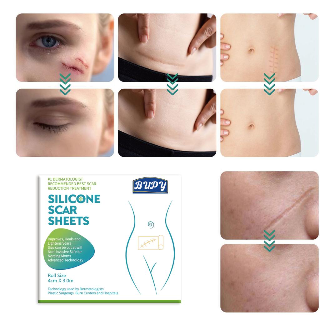 1 stk 150CM Silikongel Arrark Plaster Behandling Fjerning Tape Akne Traume Brannarr Dekke Hudreparasjon Seksjon Øre Skjønnhet