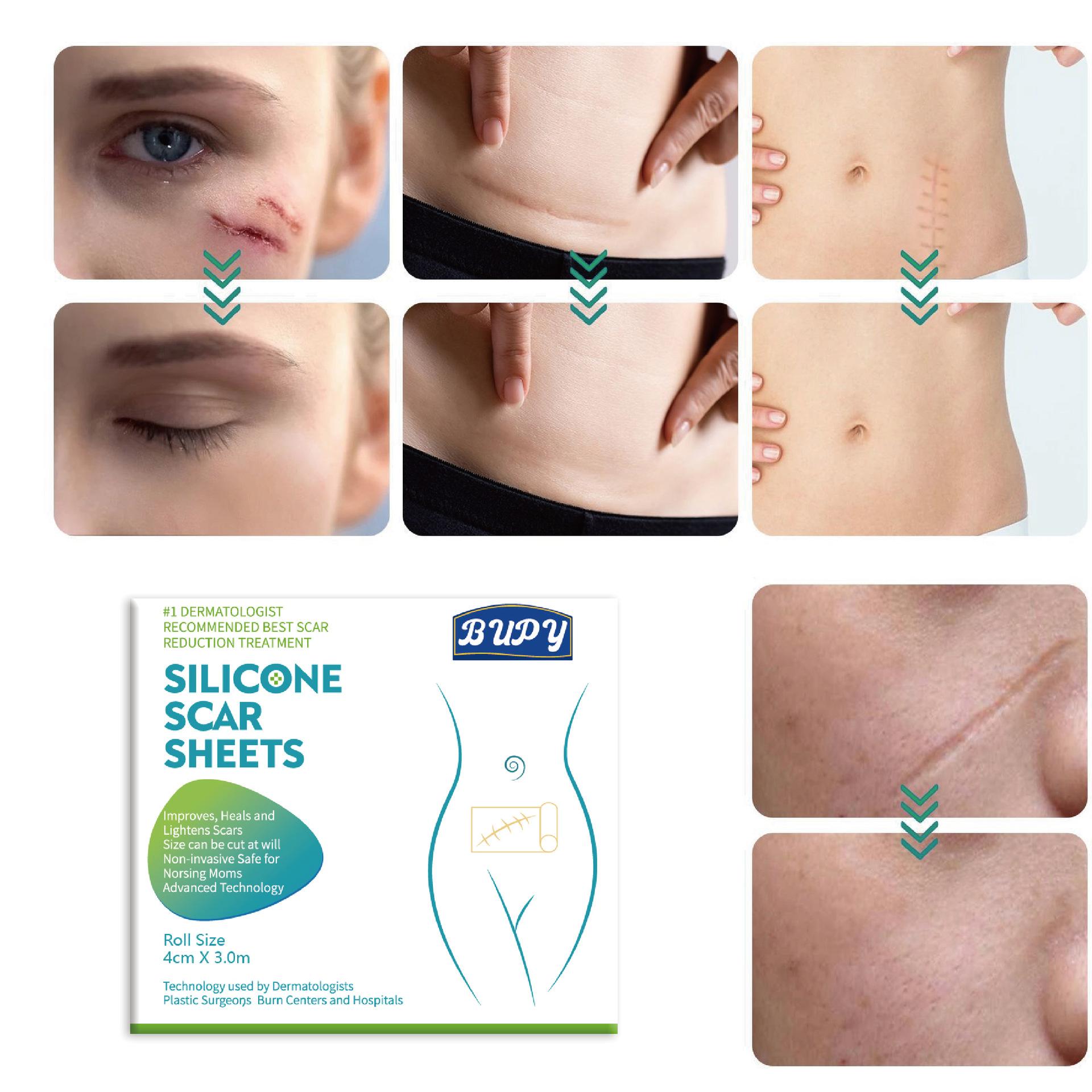 1 шт. 150 см силиконовый гелевый пластырь для лечения шрамов лента для удаления акне — фото 5