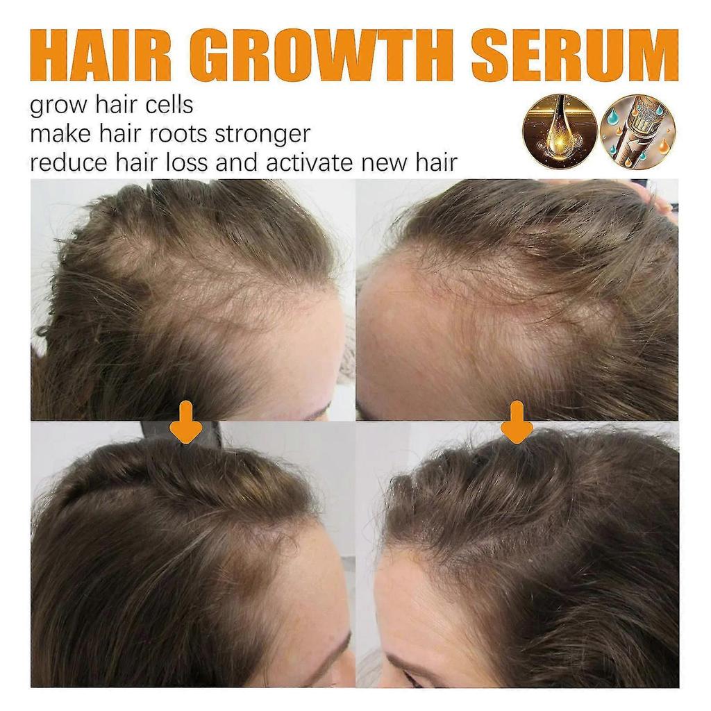 3x Biotin Haarwuchsspray Anti Haarausfall Schnelles Nachwachsen Kopfhautbehandlung Serum