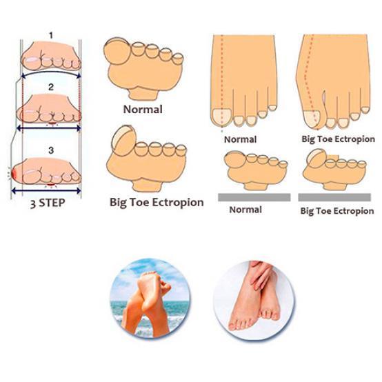 Silikonskydd Hallux Valgus-kudde Hjälp Tåseparerare Smärtlindringsverktyg