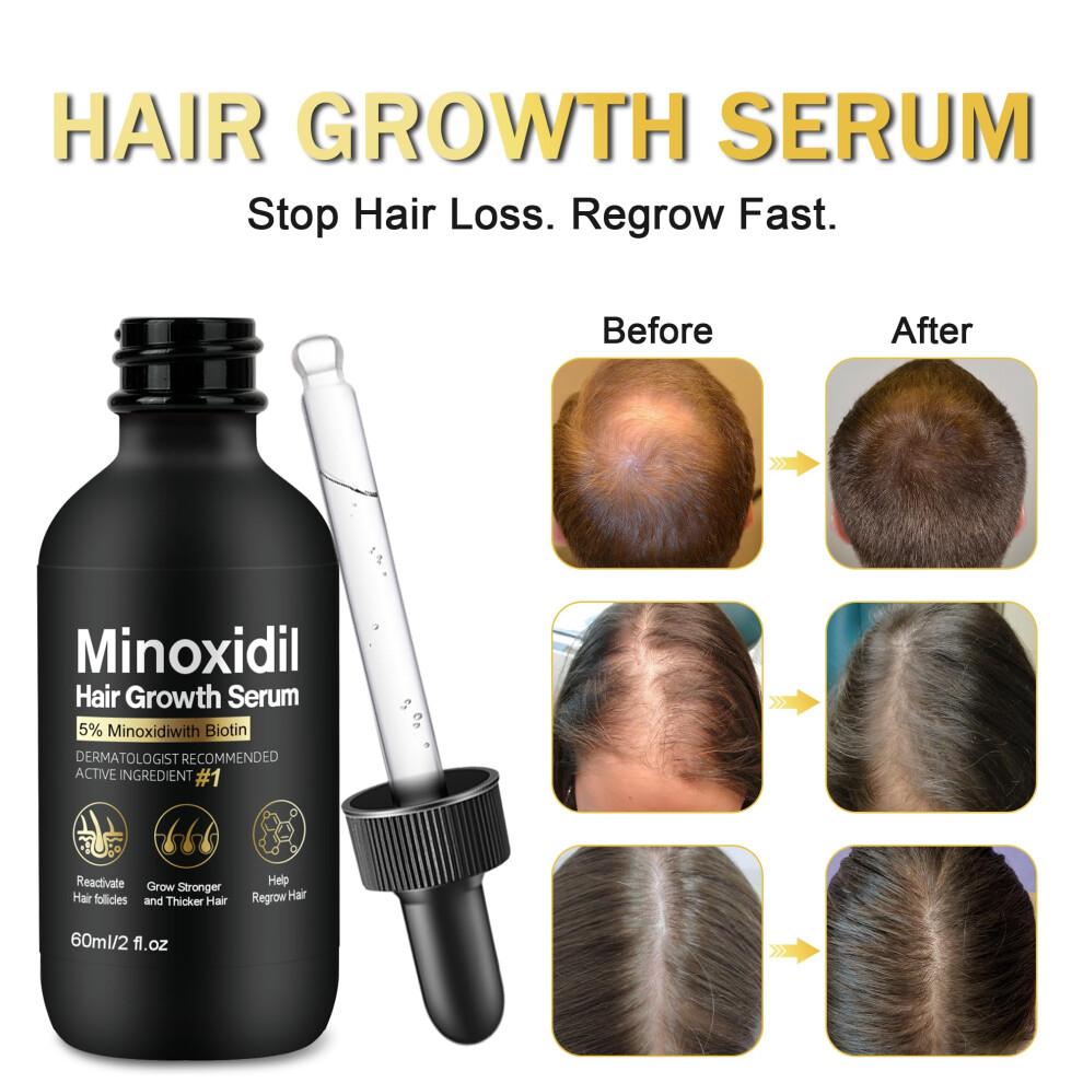 5% Minoxidil Haarwachstums-Serum mit Biotin, 60ml Haarwiederherstellungs-Behandlung gegen Haarausfall und Ausdünnung