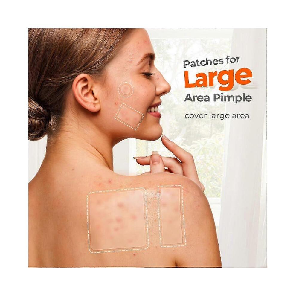 Large Pimple Patches, Acne Patches, Big Hydrocolloid Bandages for Body, Face, Forehead, Chin, Neck Zit Breakouts, Hydrocolloid Patch