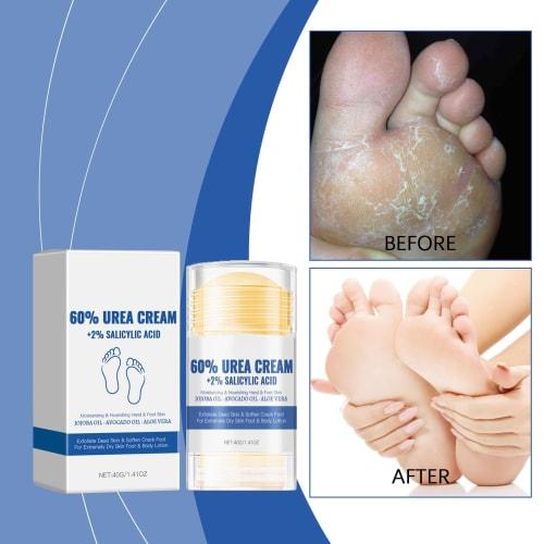 60% Urea Cream for Foot Use - Softens Dead Skin Cells, Naturally Exfoliates, and Provides Excellent Moisturizing Properties for Dry, Cracked Skin. Ide