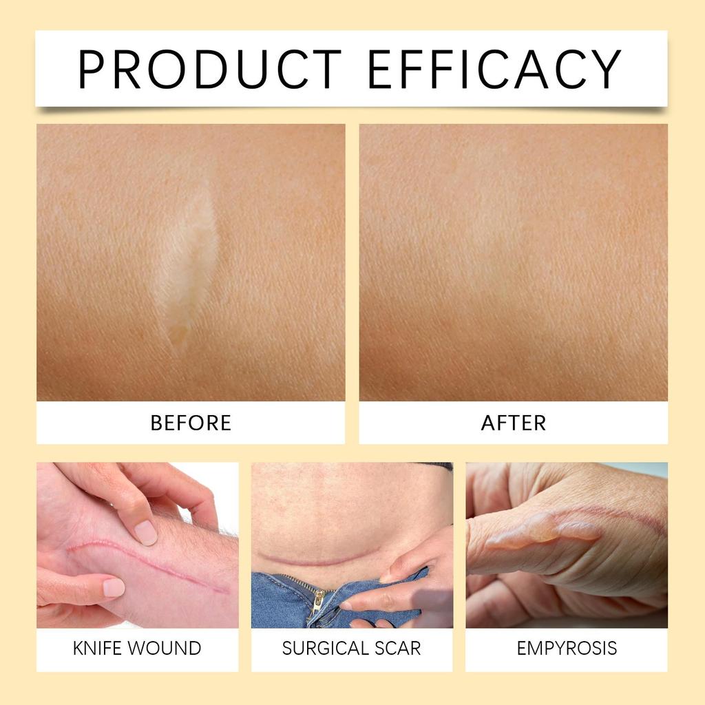 XIMONTH Bee Venom Repair Spray Promotes Skin Repair and Improves Scars Mild Formula Deeply Nourishes