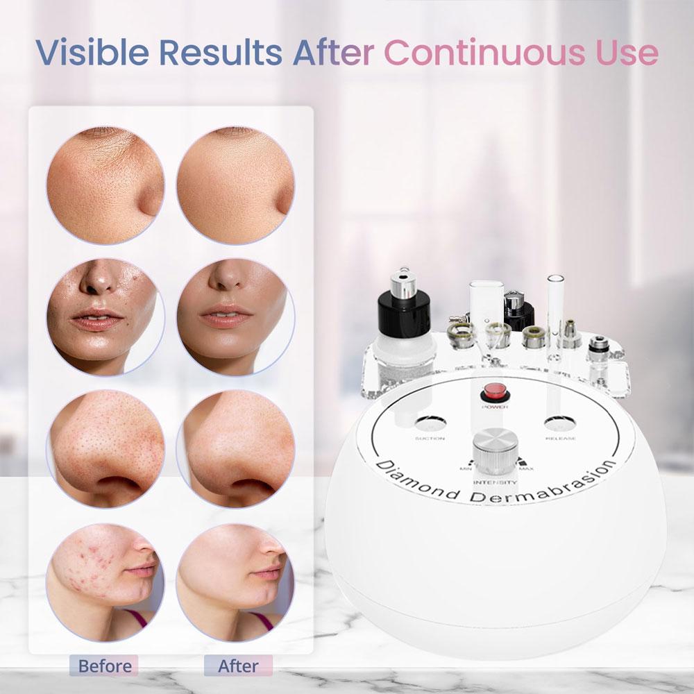 3-in-1 Diamond Microdermabrasion Machine for Face | Professional Home Skin Care Device with Vacuum Glass Tube & Spray Bottle