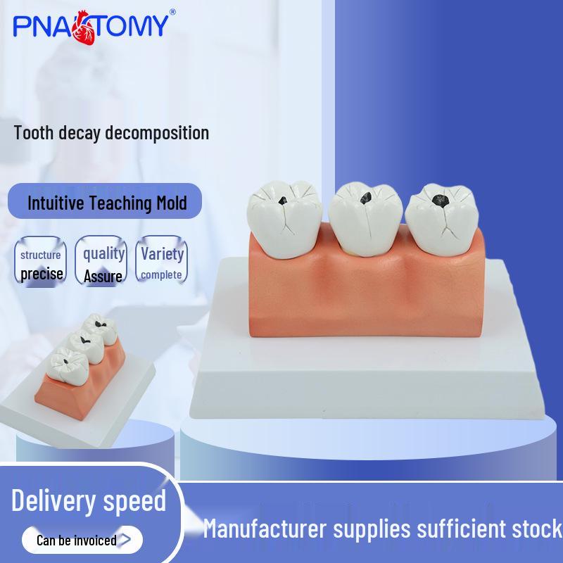 Dental Caries and Anatomy Tooth Model for Oral Health Care 18x14x10 cm