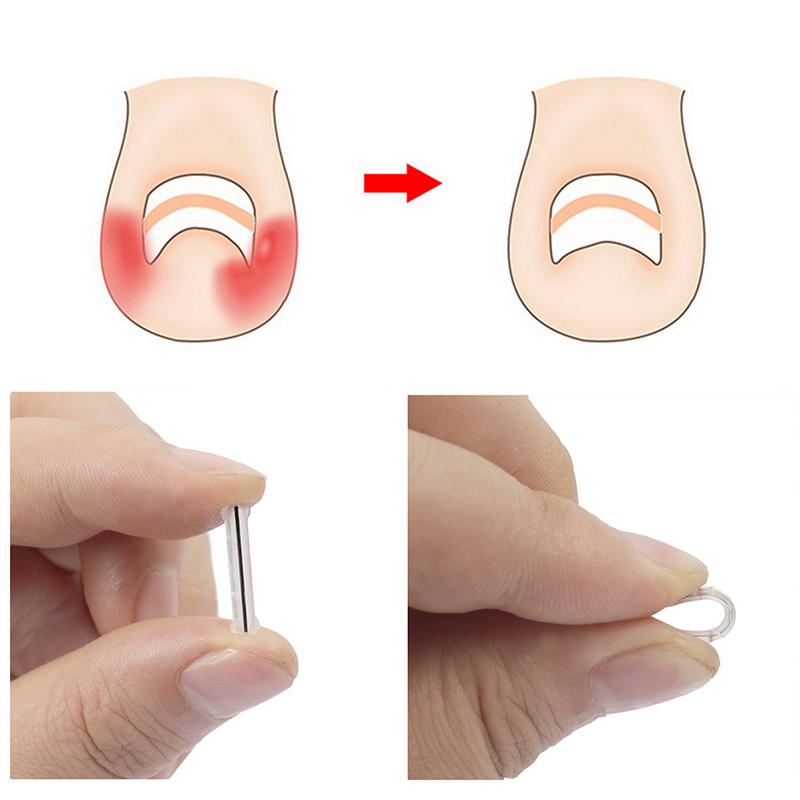 1Pcs Nail Correction Stickers Ingrown Toenail Corrector Patches Invisible High Strength Auxiliary Patch Paronychia Treatment