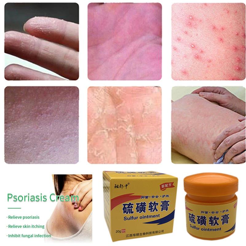 Sulfuric Moss Care Relieves Skin Itching, Redness, And Swelling. Cowhide Moss Moisturizing Skin Care