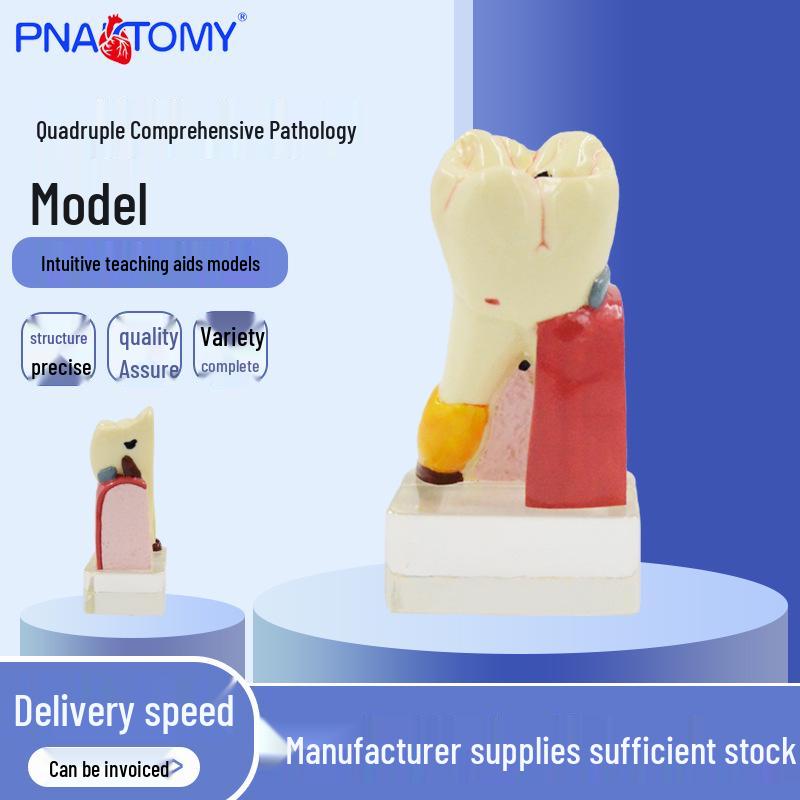 PNT-OR11 Caries and Lesion Pathology Tooth Model Resin