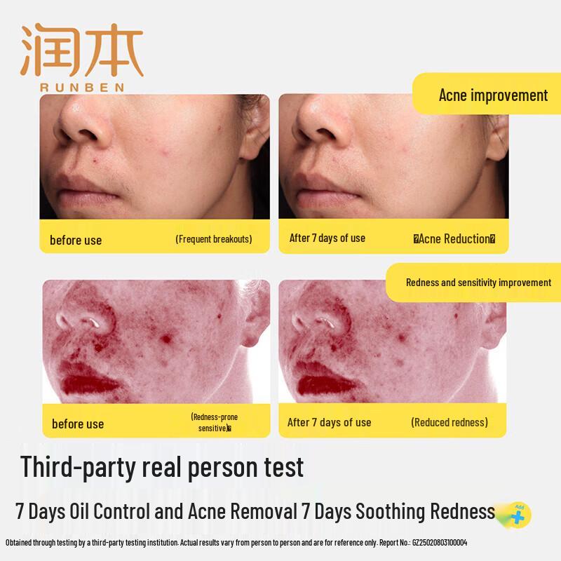 RUNBEN Youth Oil Control Acne Essence Milk