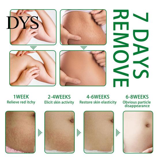 Treatment Remover 30ml Stretch Mark Spray Fast Absorption Moderate Effective Long Lasting Fade Non-Pungent Repair Damage Gentle Removal for Home Acne