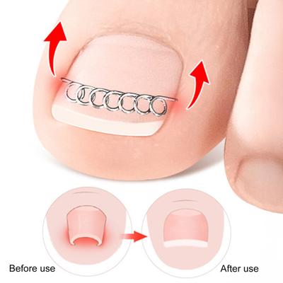 Yousheng 12 Stück Nagelkorrektur-Drahtfixierer Eingewachsener Zehennagel-Richter Nagelkorrektur-Set für Paronychie, Begradigung, Pediküre-Pflege