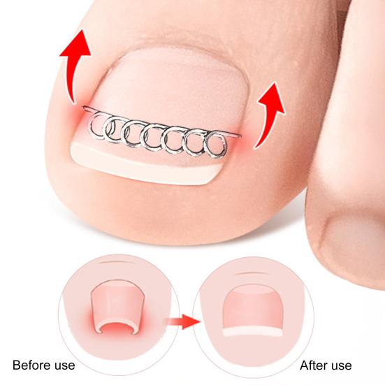 12Pcs Nail Correction Wire Fixer Ingrown Toe Nail Straightener Nail Correction Kit for Paronychia Straightening Pedicure Care