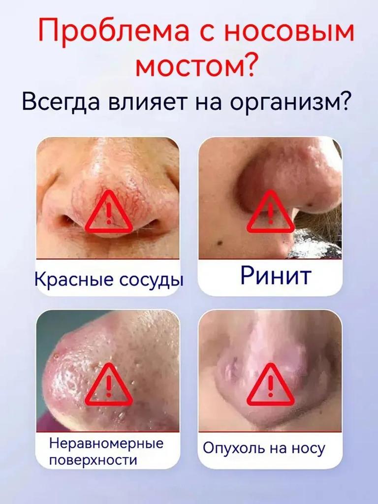 Spezialpflaster für Rosacea rote Nase Erdbeernase