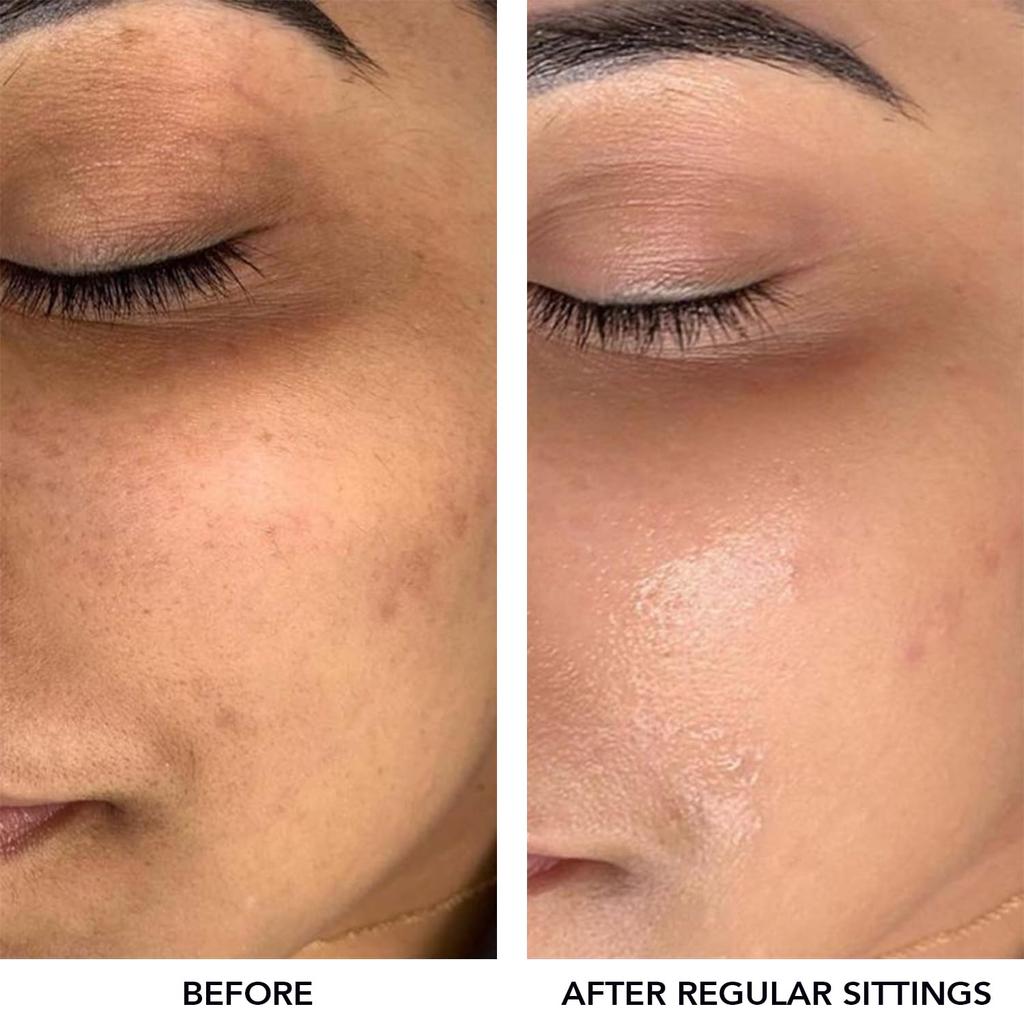 O3+ Meladerm Vitamin C Gel Bleichmittel 96g Packung für strahlend weiße Haut, zur Entfernung von Bräune und zur Aufhellung fahler Haut im Gesicht