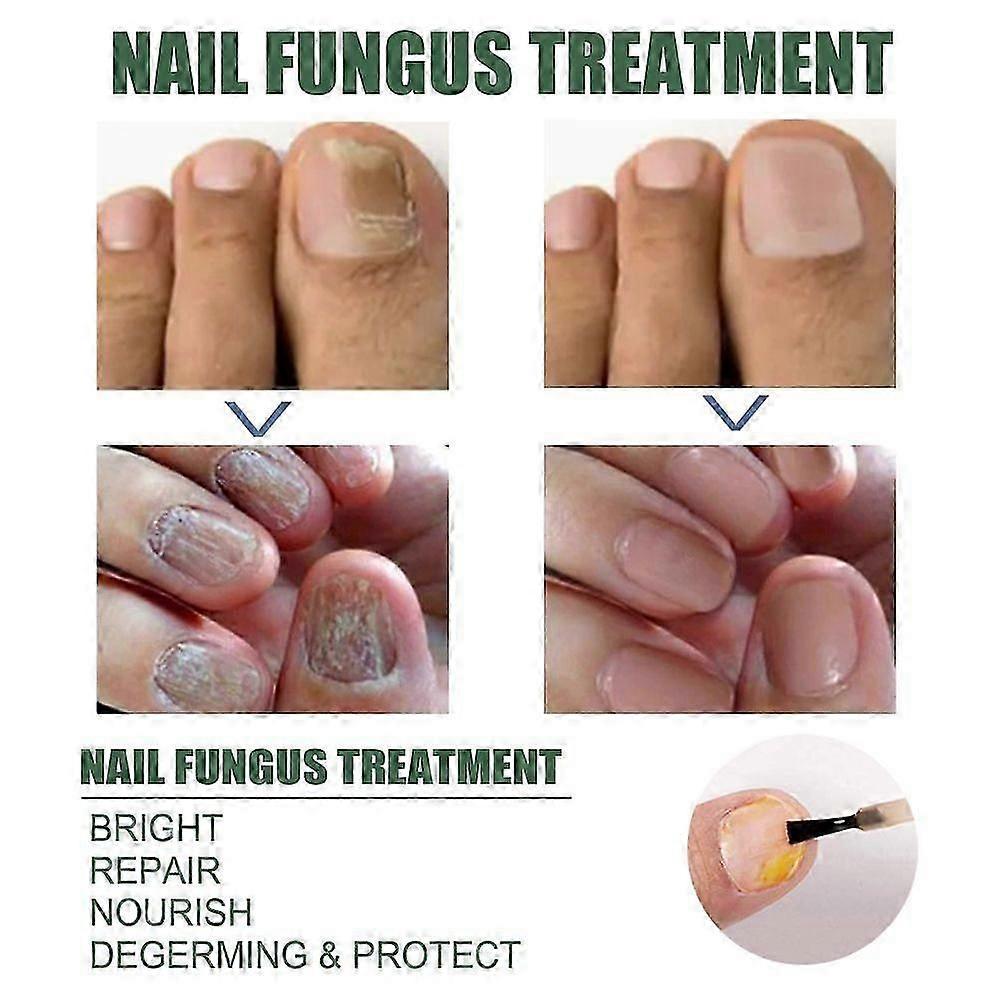 Extrem starke Nagelpilzbehandlung, beste Nagelreparatur Stoppt Pilzwachstum Effektiv