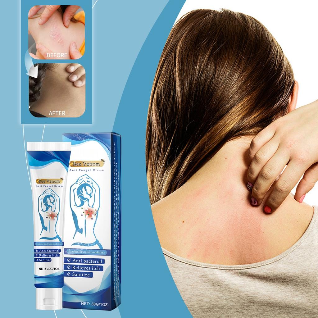 BeeAnti Fungal Cream,Fungus TreatmentCream, Itchy Skin Relief Cream,It Can Skin Ringworm Caused By Fungal .