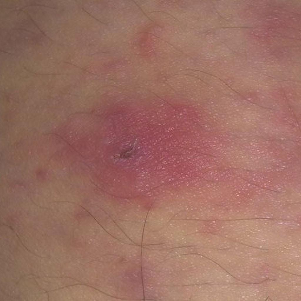 Foot Corn Remover Plaster Foot Pad Patches  Patch Pain Foot Care Tools