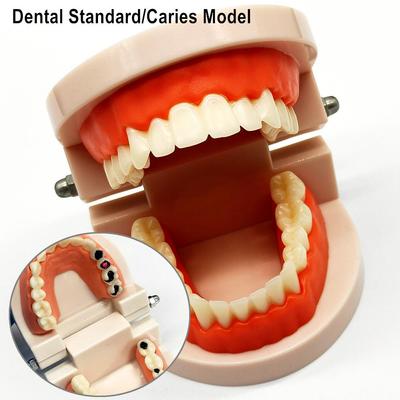 1 pièce modèle de dent dentaire modèle de dents standard modèle de carie dentaire pour la communication avec le patient modèle d'étude de dentiste avec dent cariée