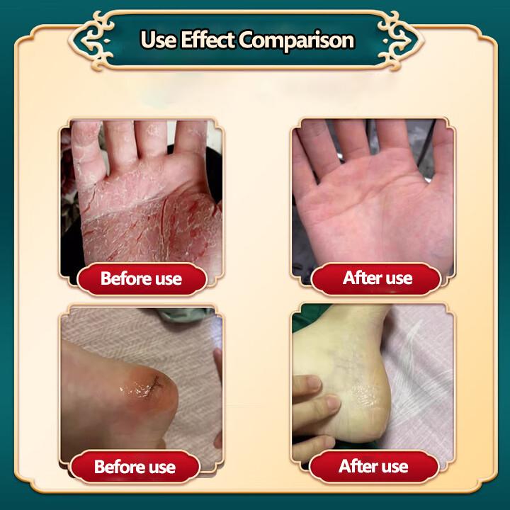 Cremă specială de vindecare pentru mâini și picioare crăpate, piele uscată pe mâini și picioare, prevenirea crăpăturilor degetelor, cremă pentru degerături și crăpături în timpul iernii