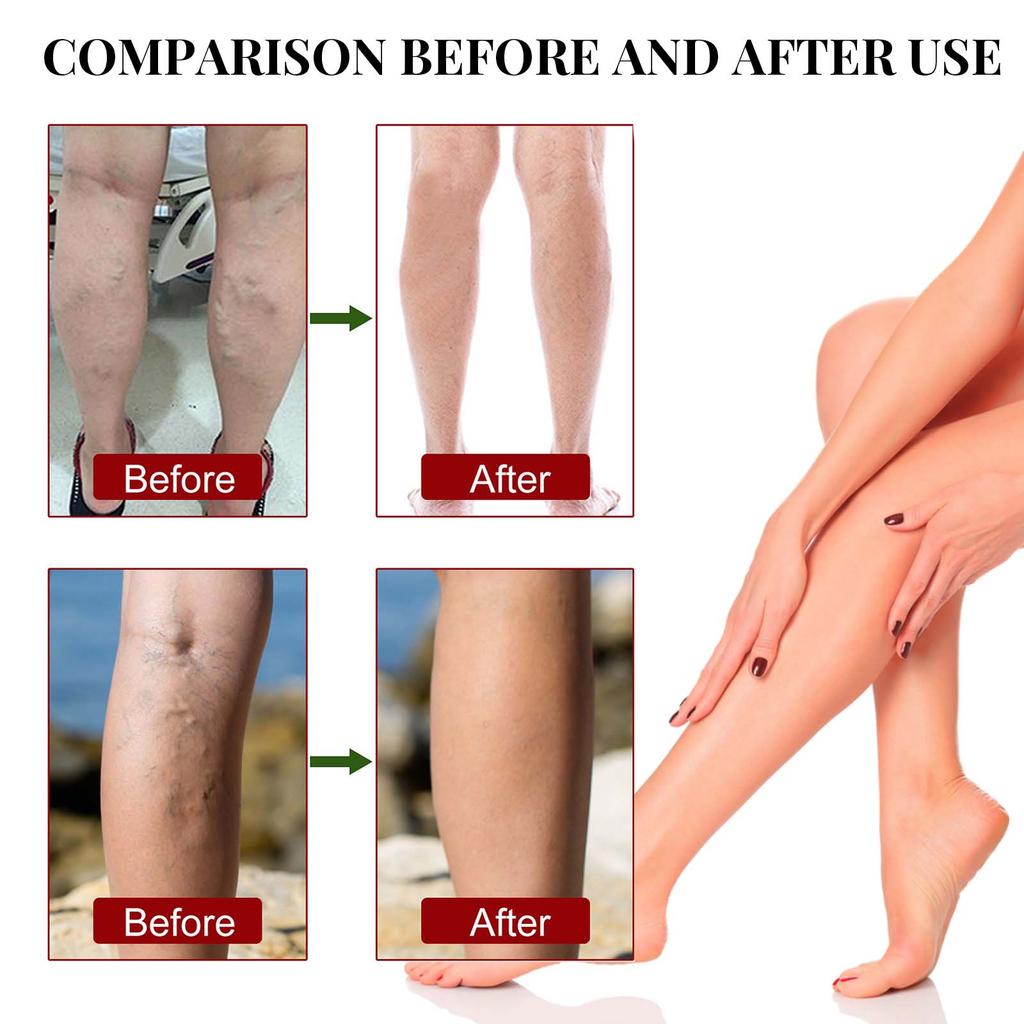 100ml  Repair Earthworm Legs Relieve Sore Legs Leg Massage Treatment Spray