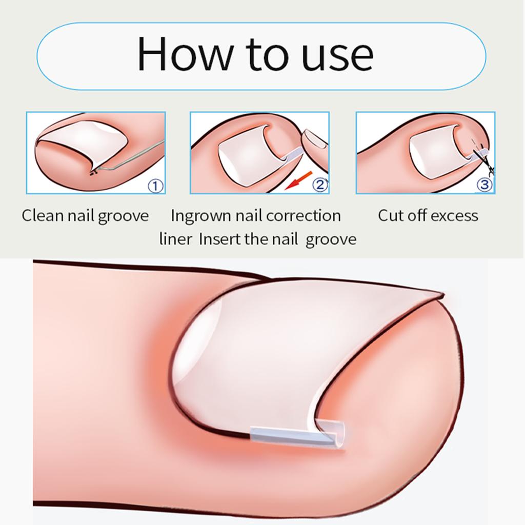 Toenail Correction Tool Toe Nail Treatment Elastic Patch Sticker Straightening Clip Brace Pedicure Tool
