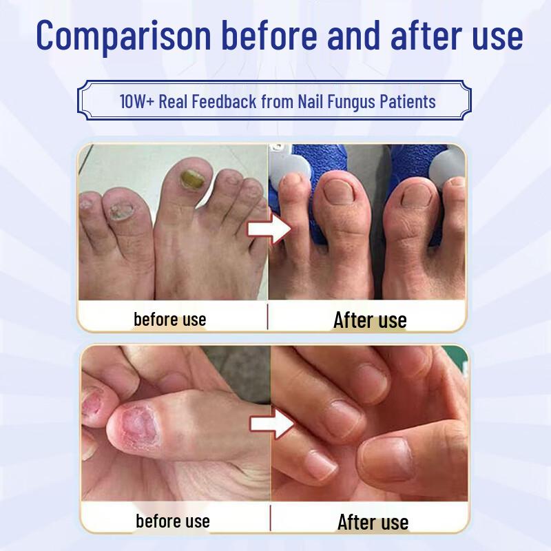 Jingpeitang Onychomycosis Nail Repair Solution