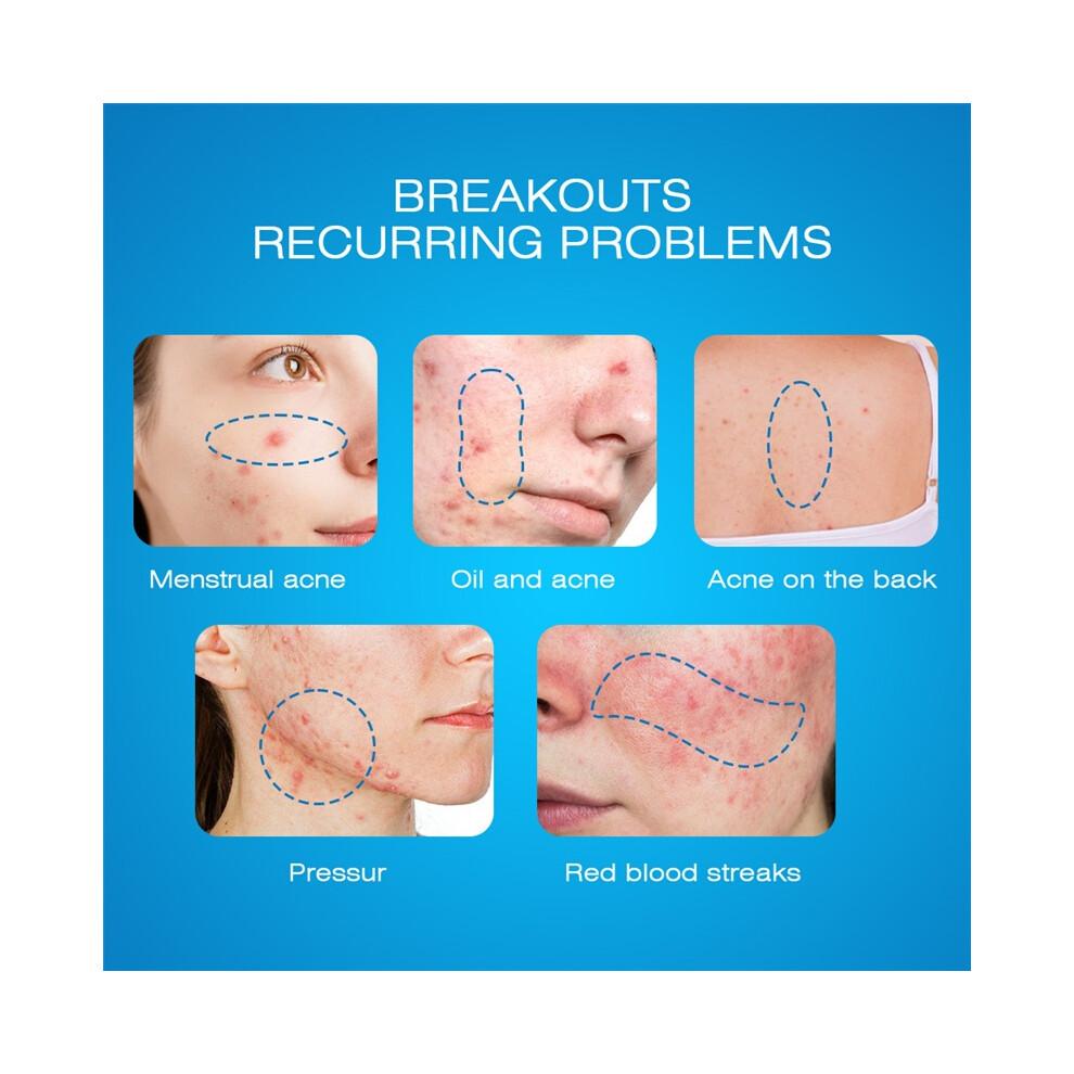 (20g) Brightening Cream Acne, Acne, Scar Skin Care Cream