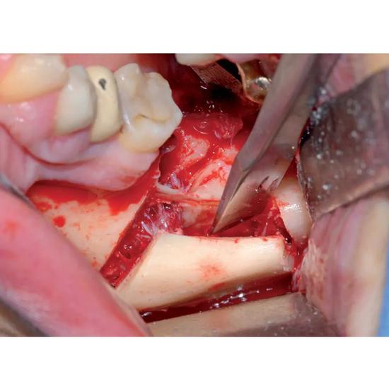 GDC Bone Chisel Chandler (7mm) (CC9)