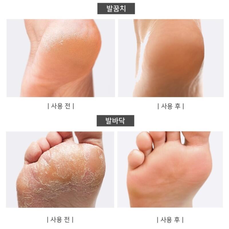 Foot Angel Callus-busting Foot Callus Remover Foot Care Moisturizing Serum 1 Ea