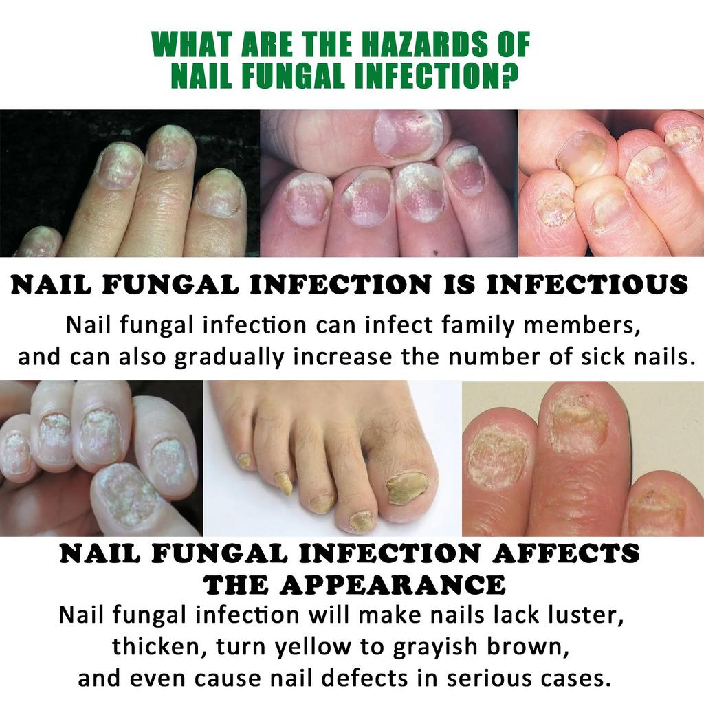 7Days Nail Fungus Treatment Serum Ginger  All Plant Anti-infective Paronychia Onychomycosis Toe Foot Nail Fungal Repair Gel Hand Foot Care