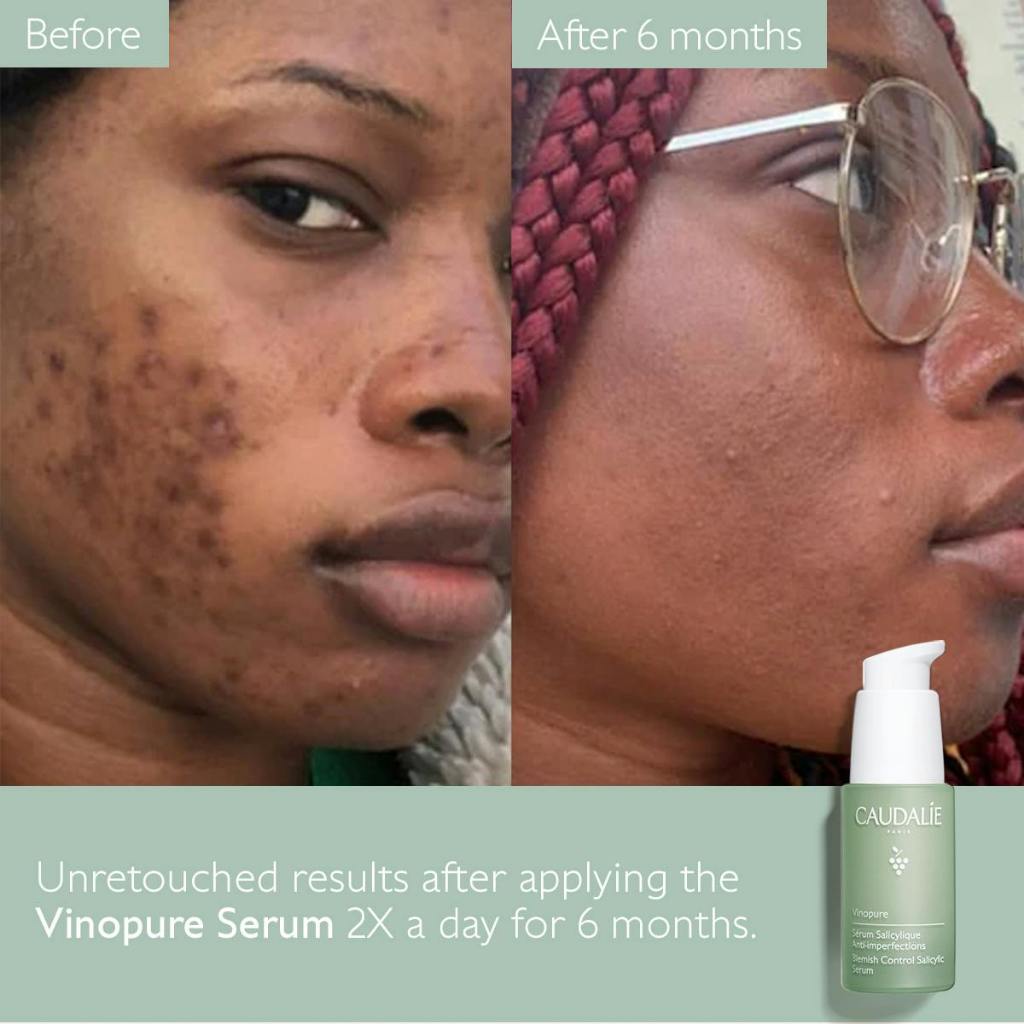 Caudalie Vinopure Blemish Control Salicylic Acid Serum 30ml