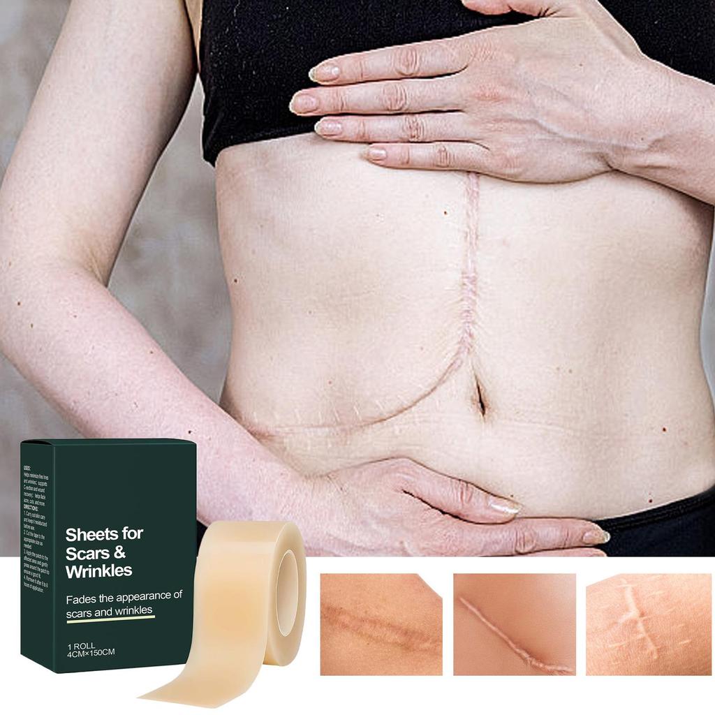 Silicone Scar Patch Skin Repair Sheets Removal Self-Adhesive Stretch Mark Tape Therapy Patch For C-Section Burn Acne Scar
