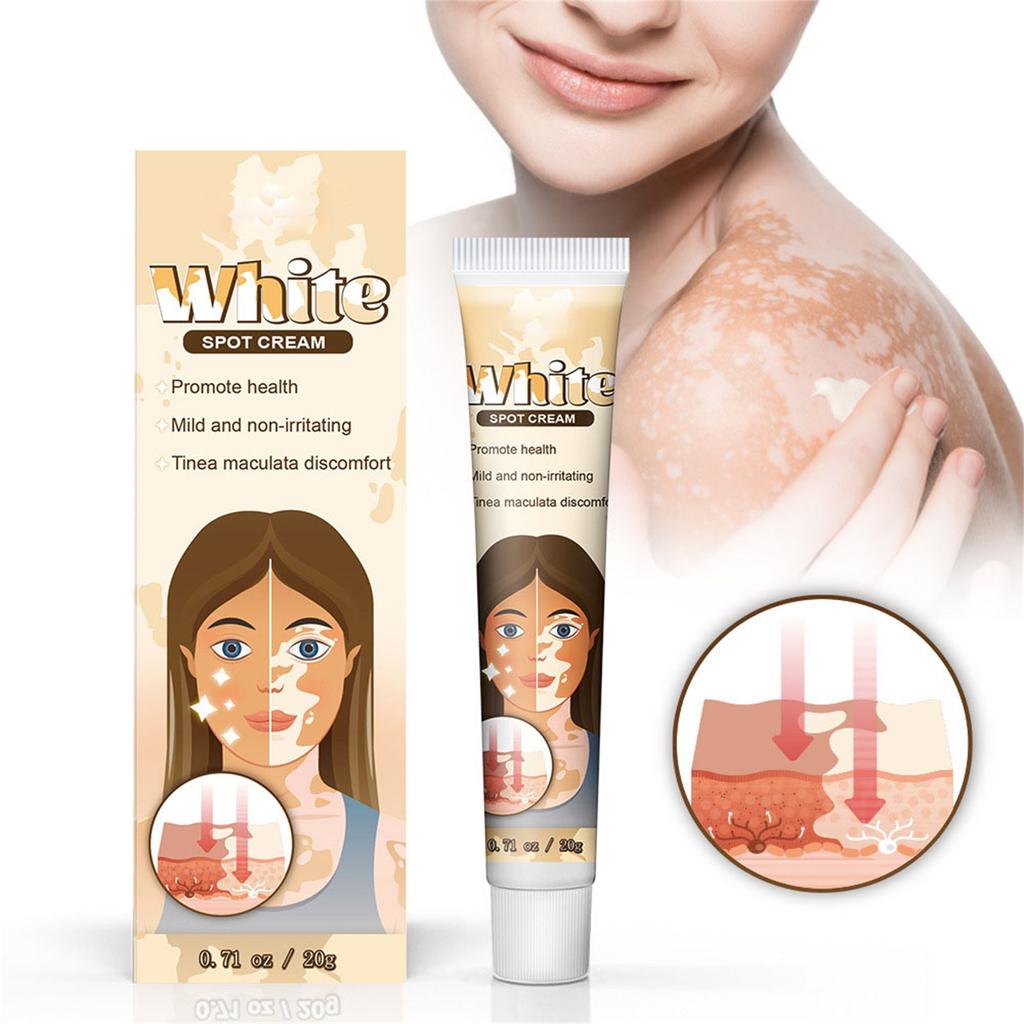 Vitiligo Cream, Natural Vitiligo Ease For Skin Vitiligo, Vitiligo Care Cream, Reduce Spots And Improve Skin Pigmentation, Easy To Use