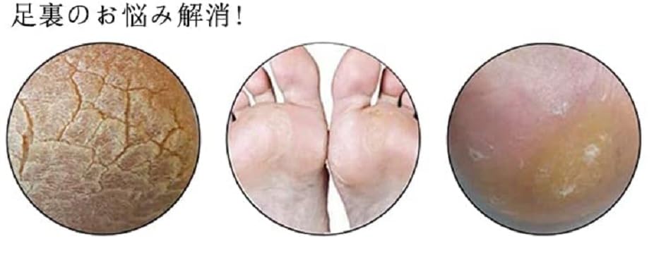 Generic Brands Heel Callus Foot Stainless Steel for Safe and Effective Callus Suitable for Dry and Wet Heel Care Remover, Exfoliator, Micro-Cutter