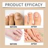 Breathable Curved Toenail Corrector Set; Toenail Correction Stickers; Nail Care