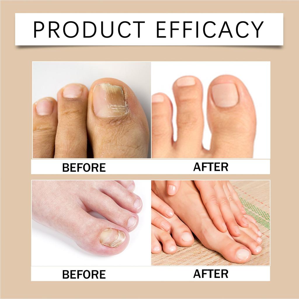 Breathable Curved Toenail Corrector Set; Toenail Correction Stickers; Nail Care