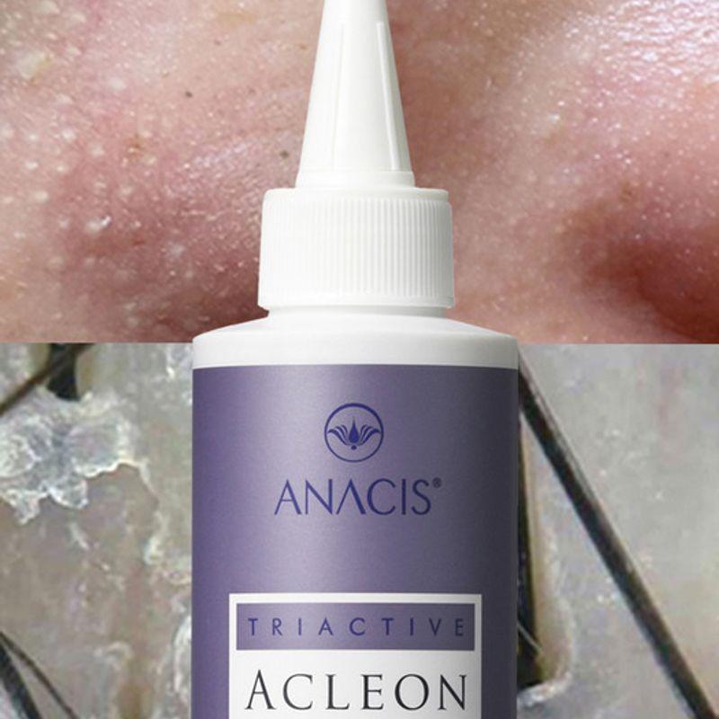 Acleon Sebum Removal Seboex 200ml (15ml Pore Ampoule Included)