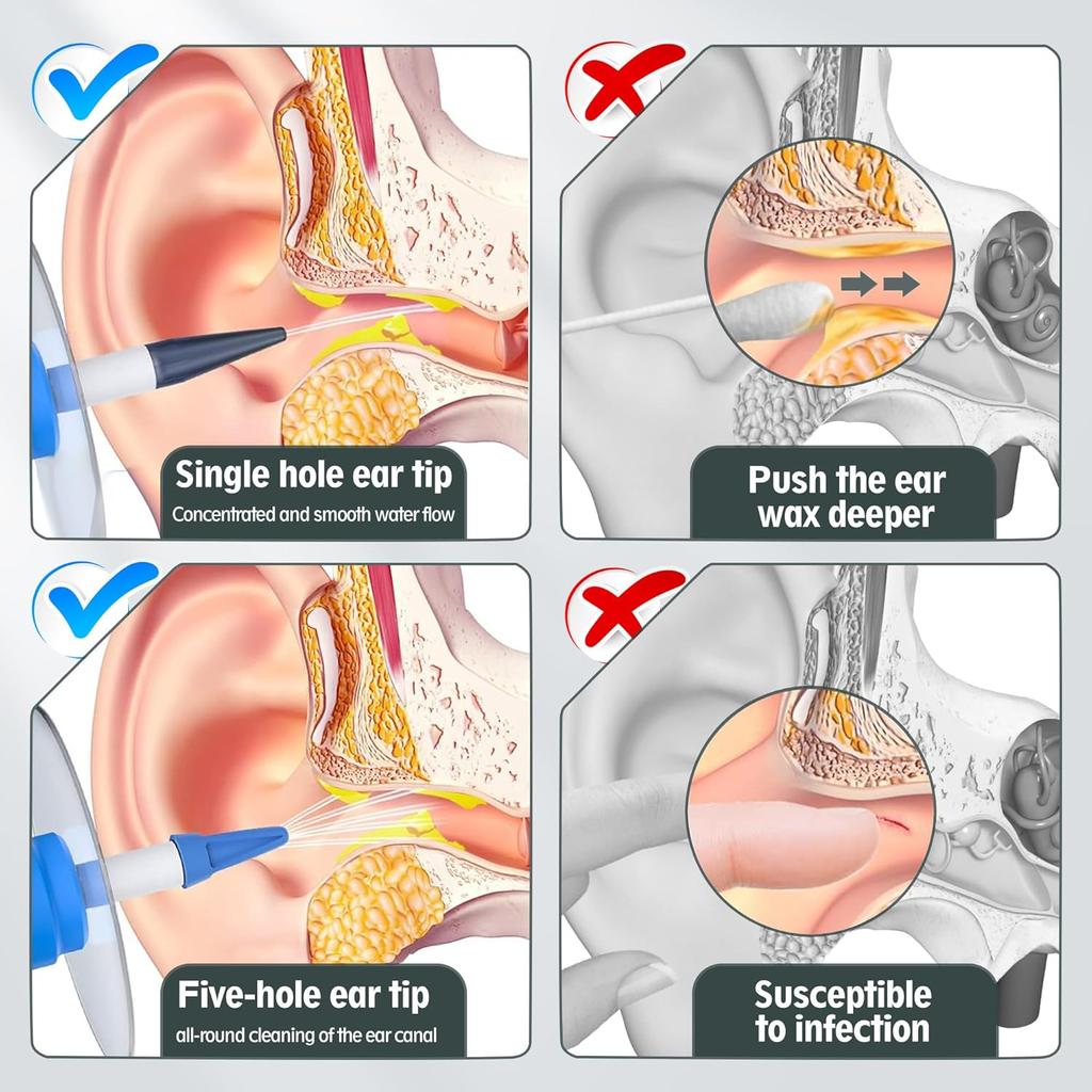 Durable And Safe Ear Wax Removal Tool Manual Ear Irrigation Flushing Kit Ear Cleaner Full Set Of Cleaning Tools And 30 Disposable Soft Ear Tips