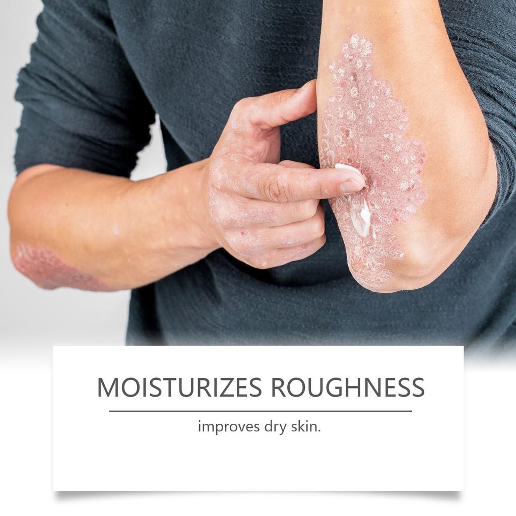 Skin Moisturizing Cream Soothes Discomfort, Moisturizes Dry Skin, And Maintains The Skin Barrier